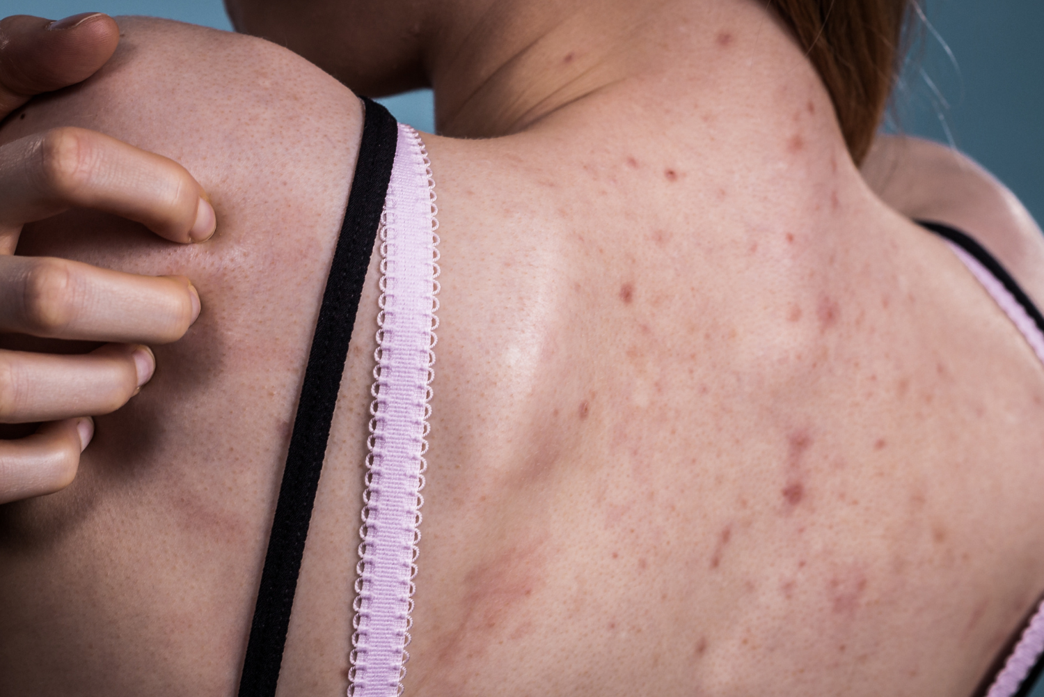 acne en la espalda de una mujer delgada